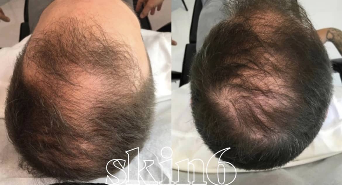 Hair restoration before and after