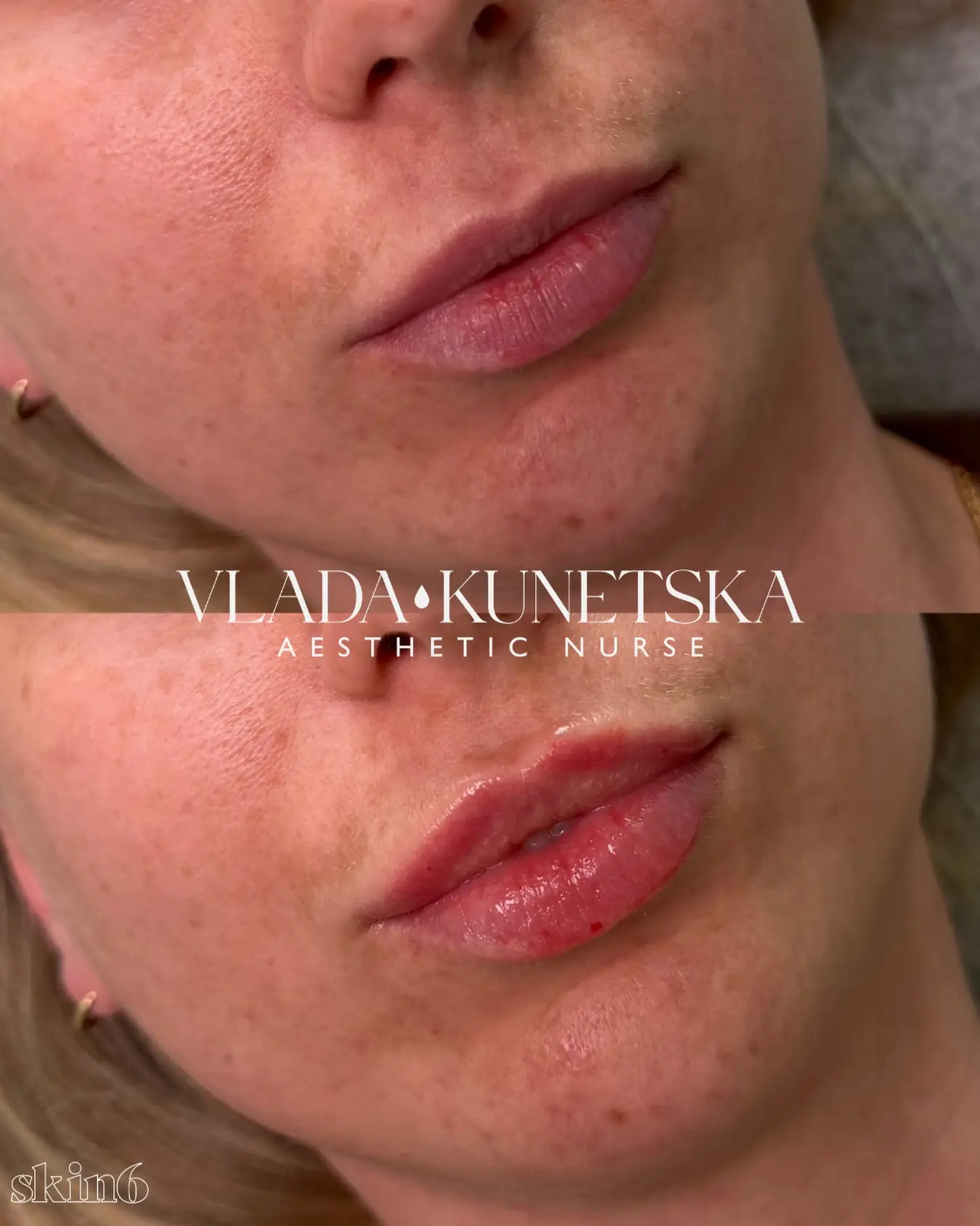 Client transformation results at Skin6 Toronto