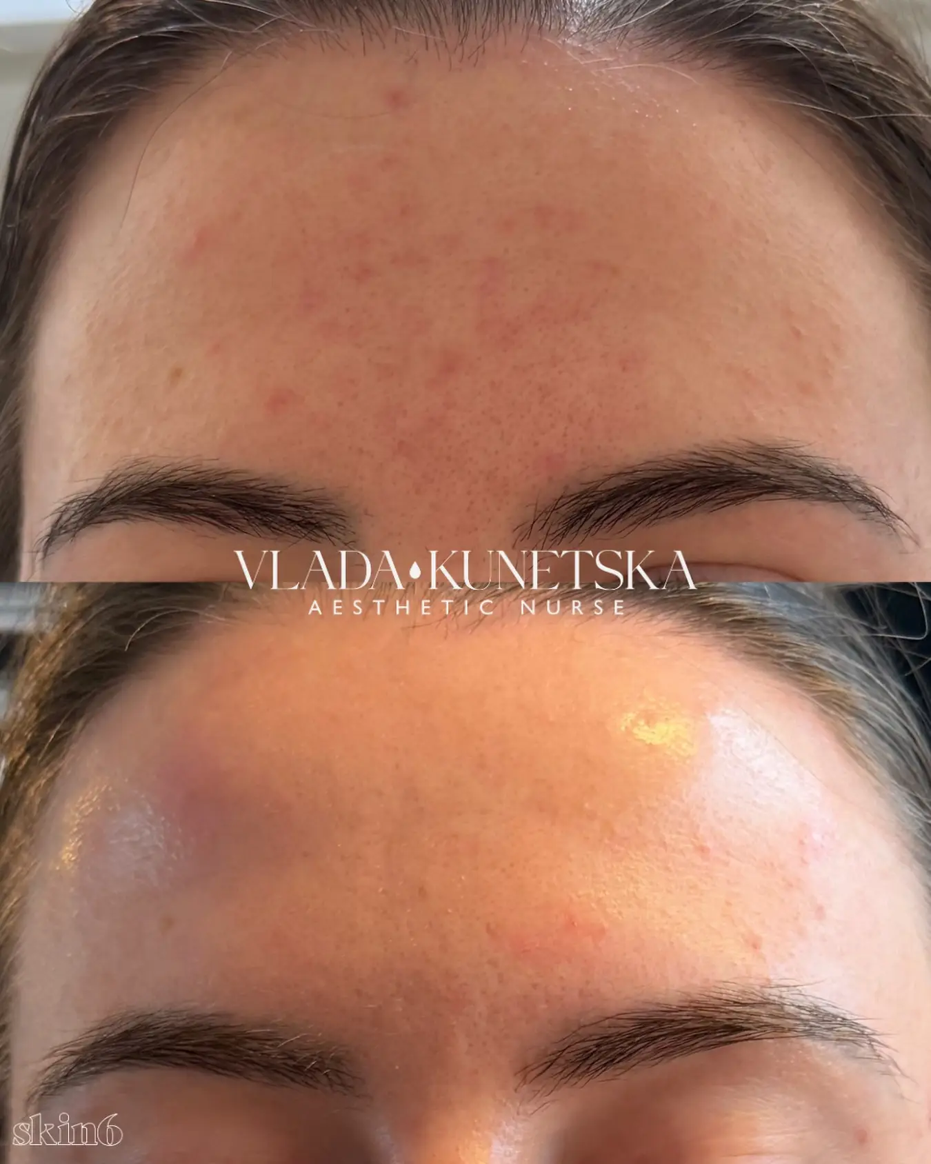 Combination treatment before and after at Skin6 Toronto