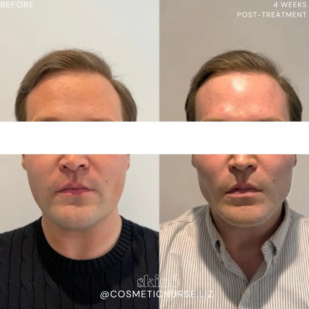 Facial contouring filler results at Skin6 Toronto