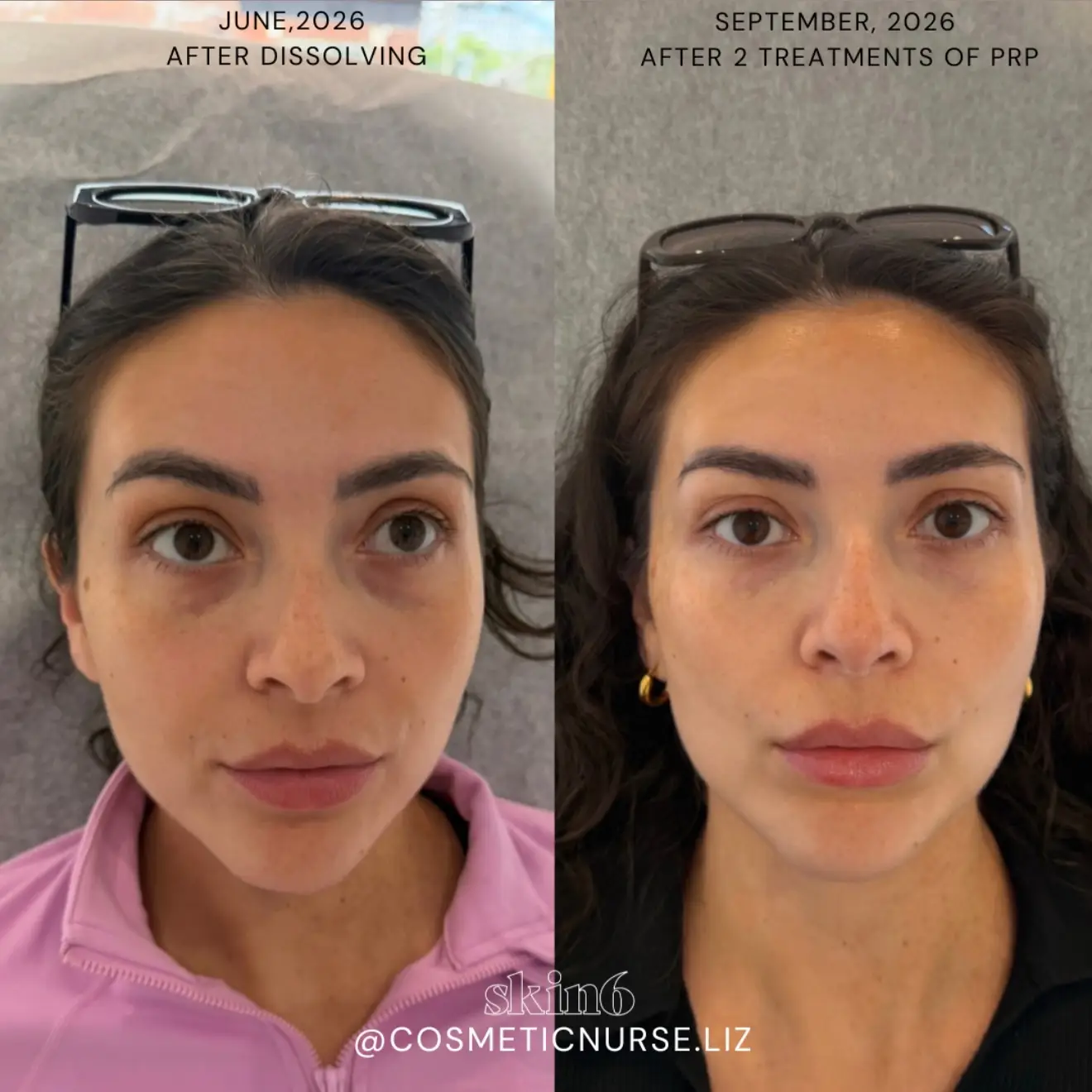 Filler migration correction results at Skin6 Toronto