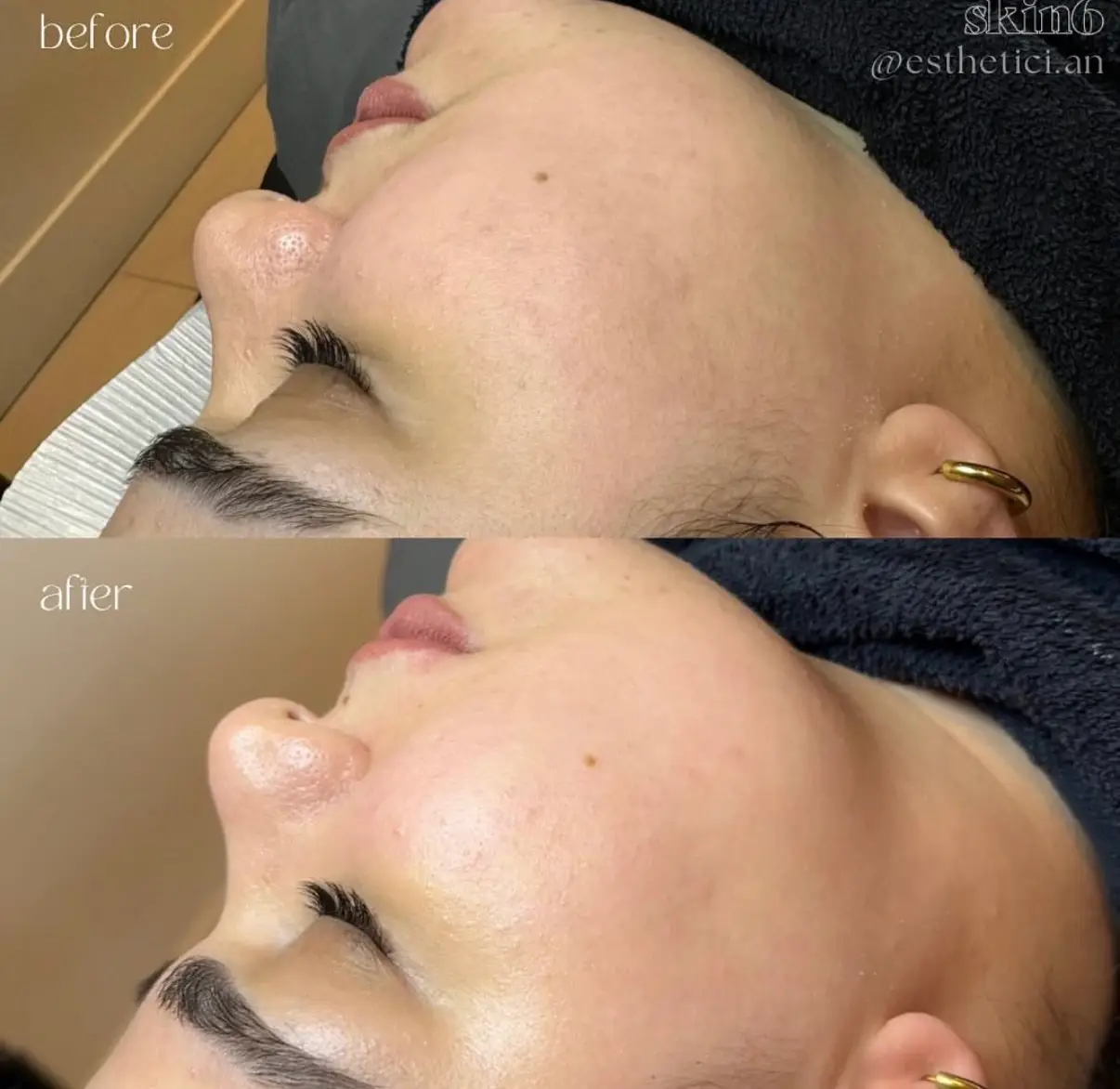 HydraFacial before and after results at Skin6 Toronto