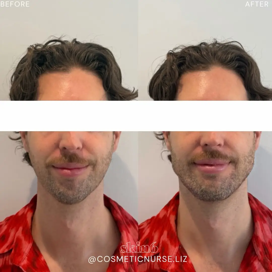Jawline and chin enhancement results at Skin6 Toronto
