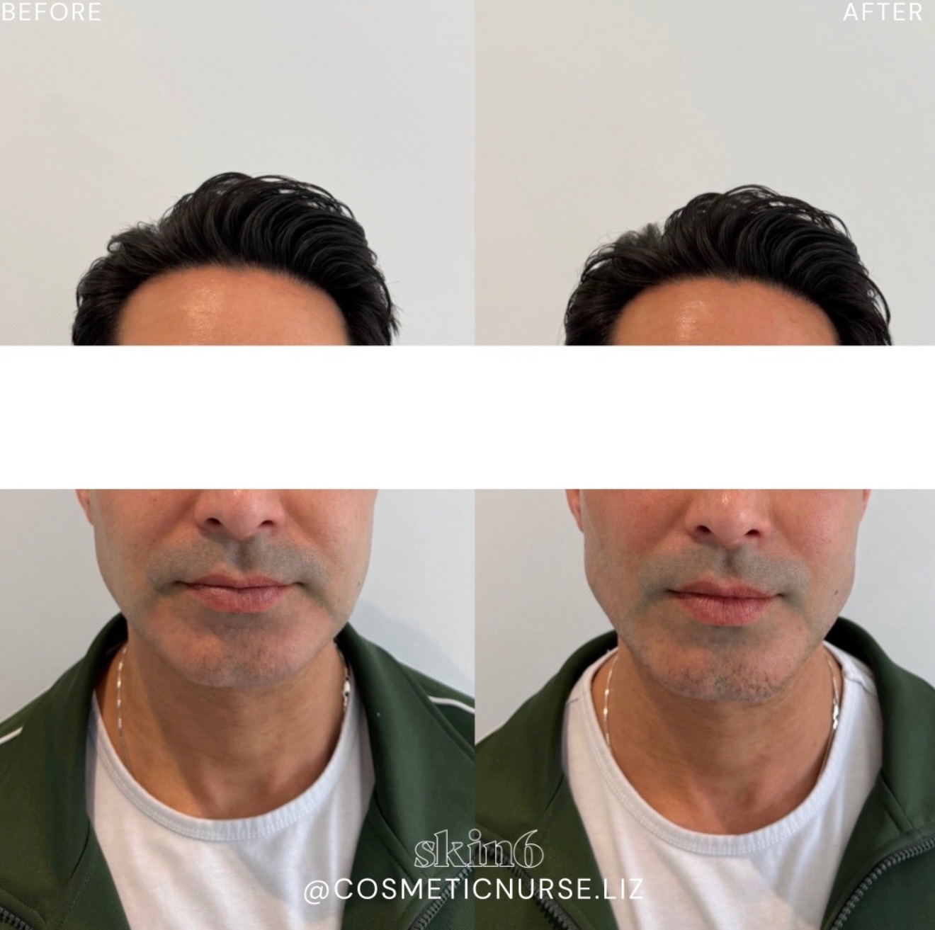Sculpted jawline and chin results at Skin6 Toronto