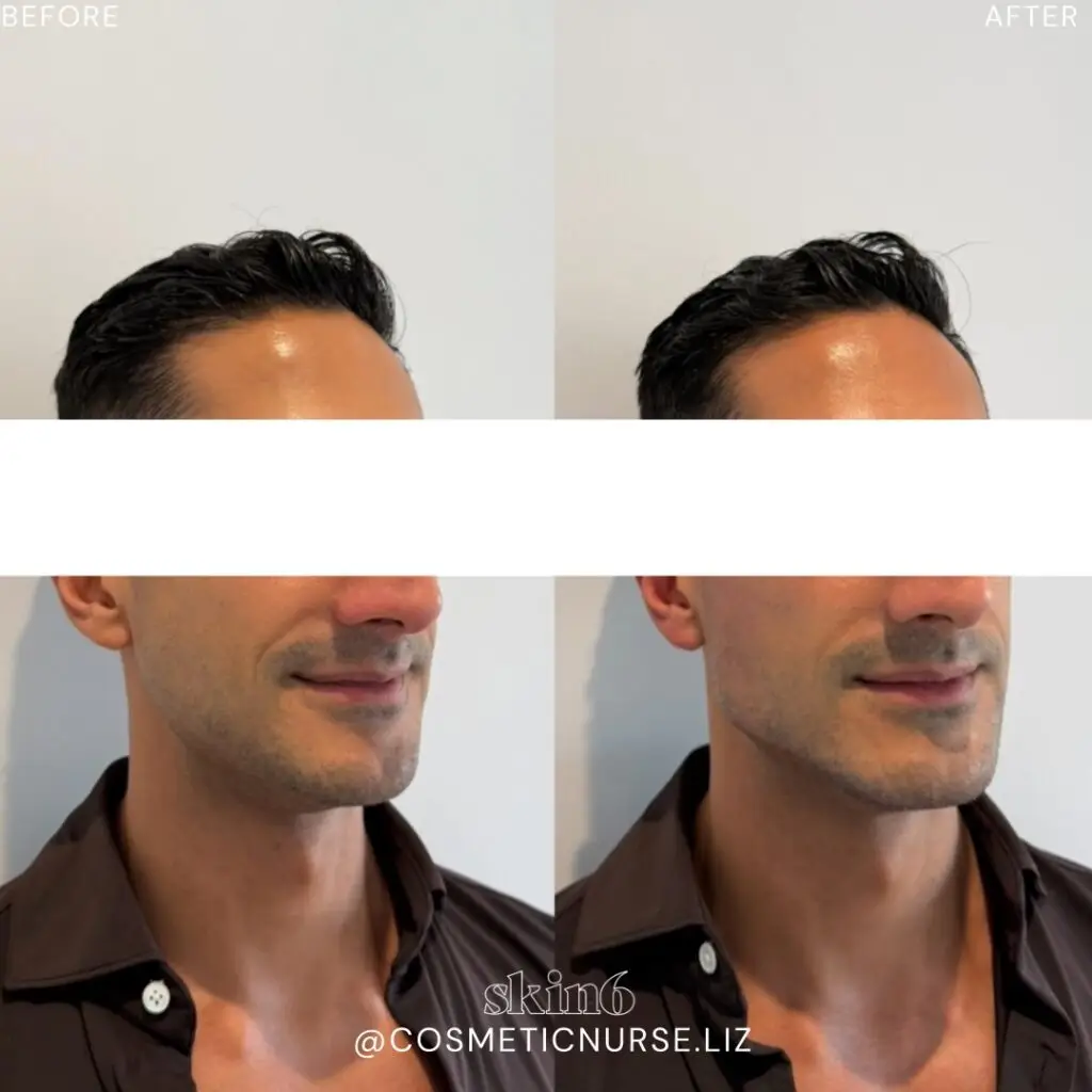 Jawline and chin enhancement results at Skin6 Toronto