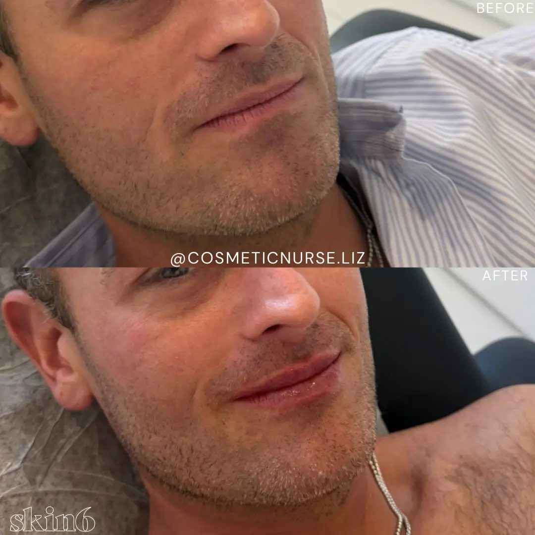Natural lip enhancement results at Skin6 Toronto