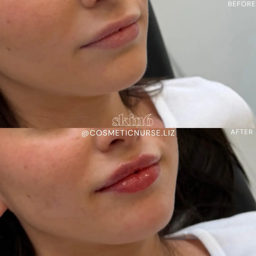 Beautiful lip filler results at Skin6 Toronto