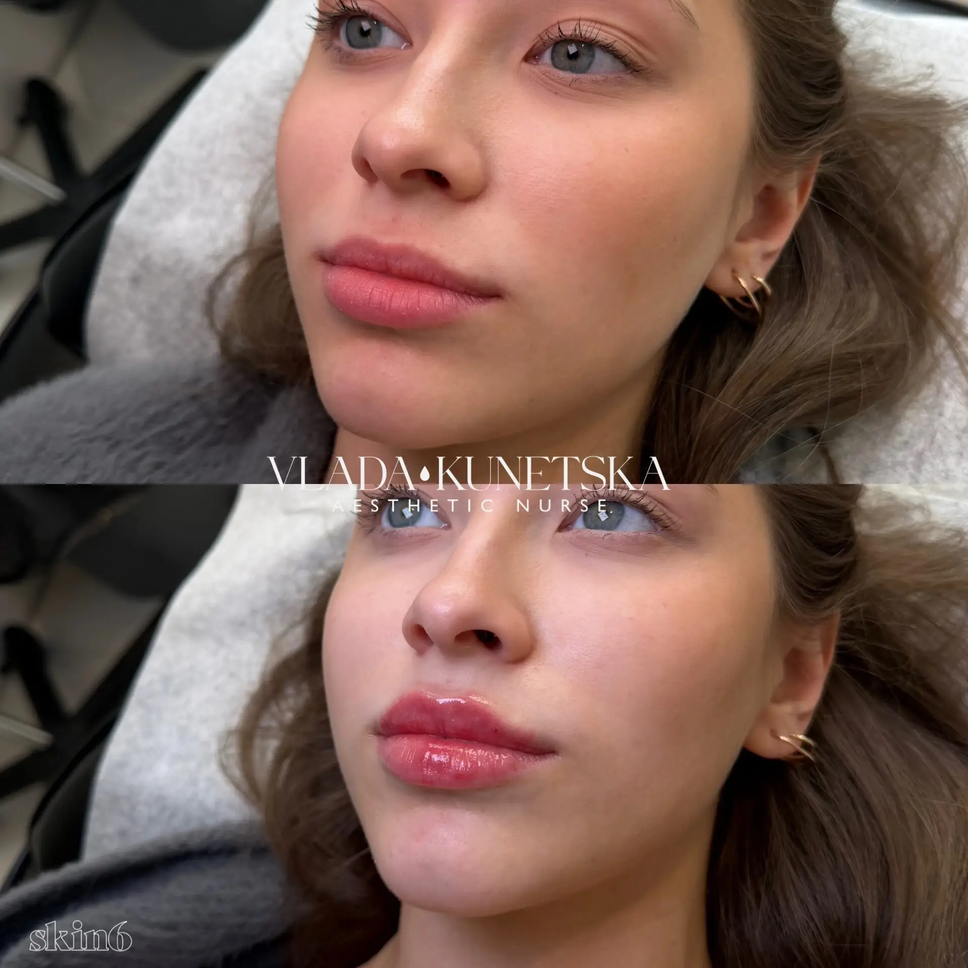 Lip filler results at Skin6 Toronto