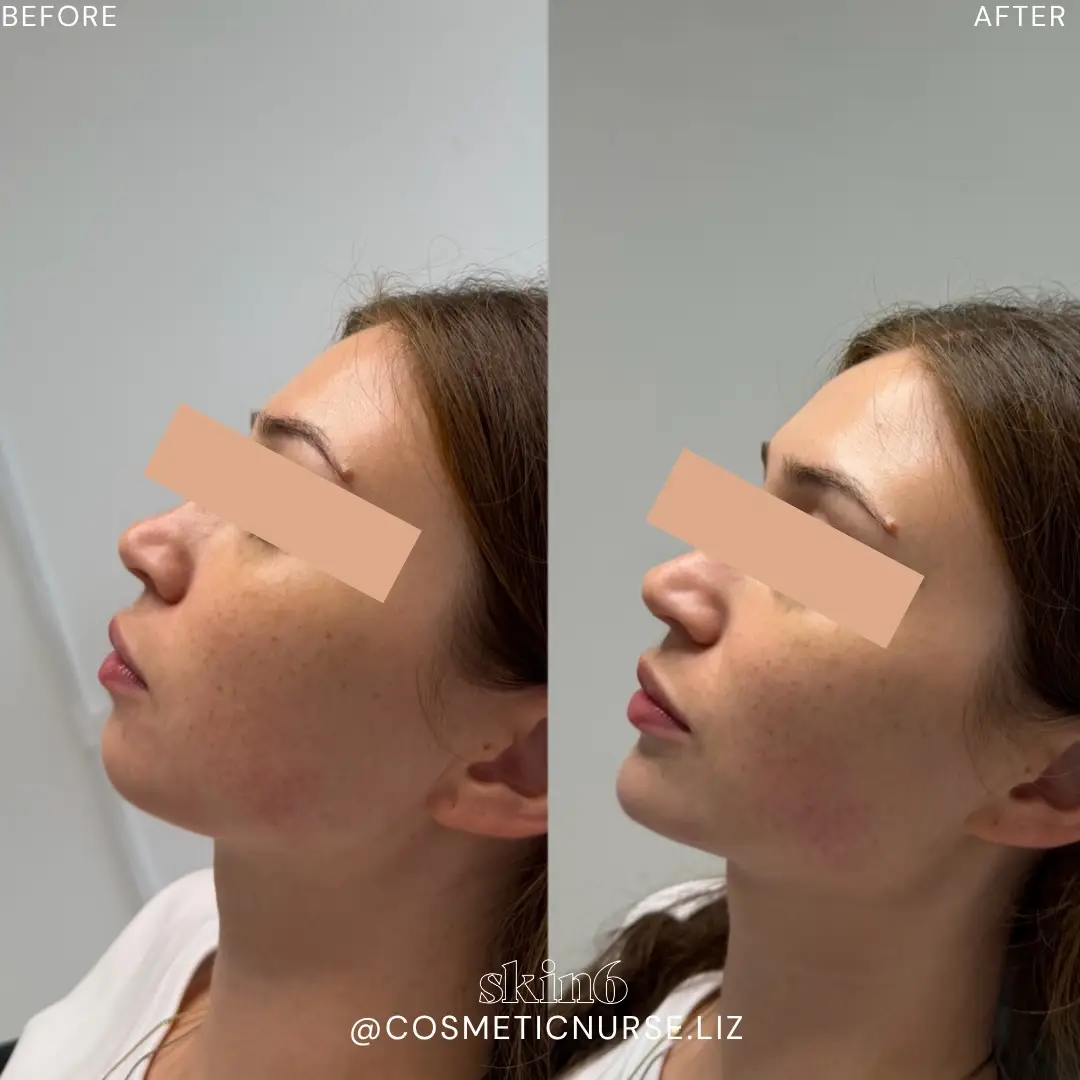 Lower face balancing results at Skin6 Toronto