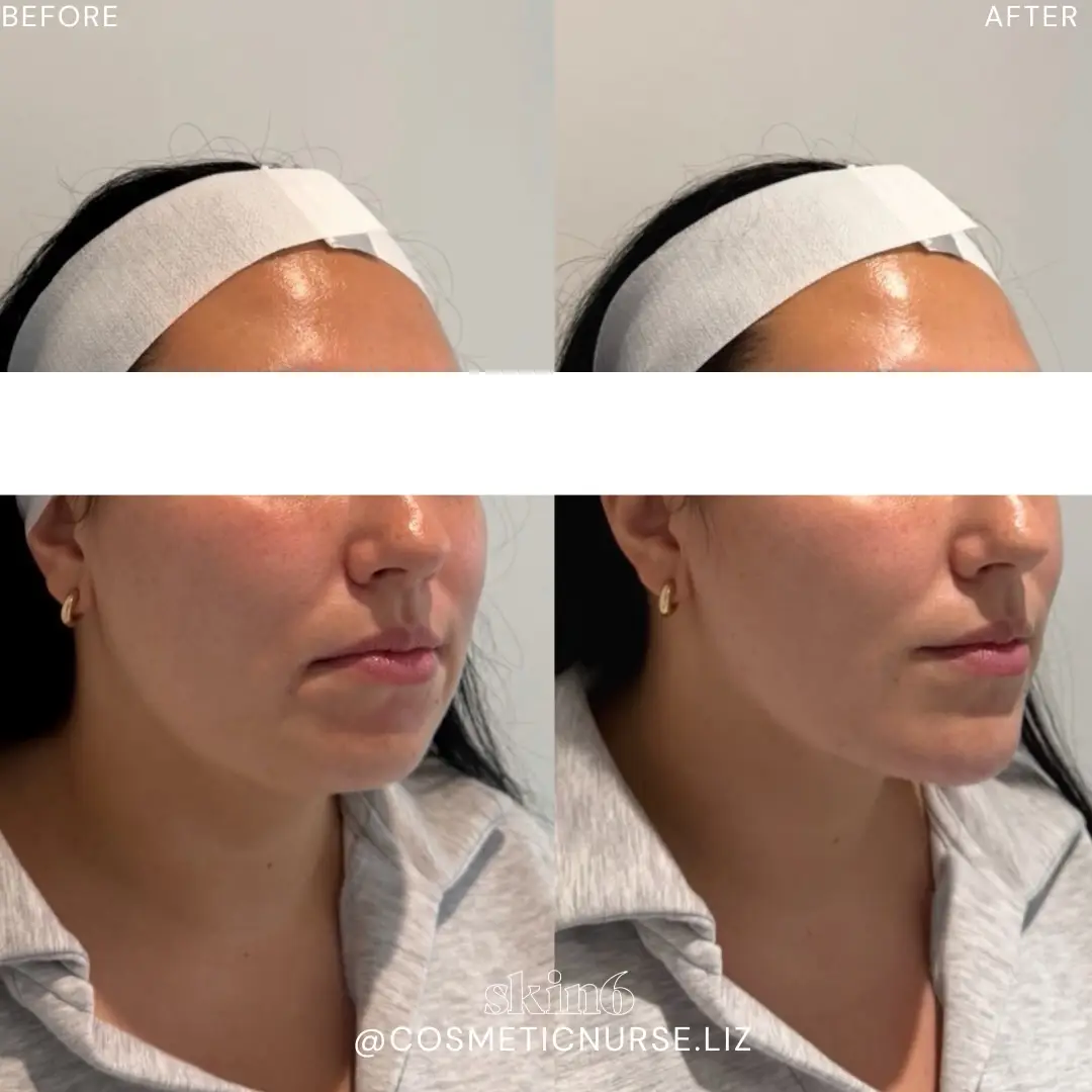 Lower face enhancement results at Skin6 Toronto