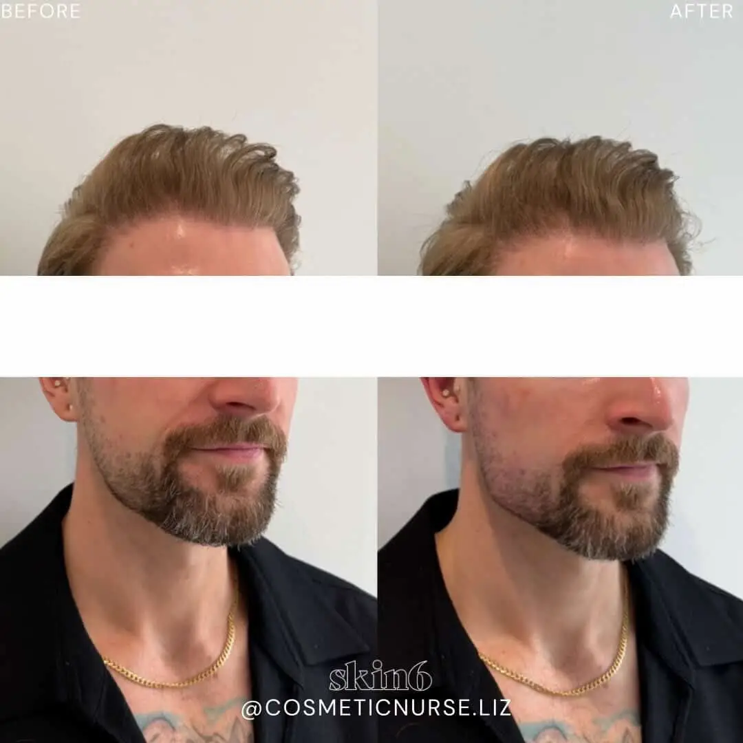 Lower face top-up results at Skin6 Toronto