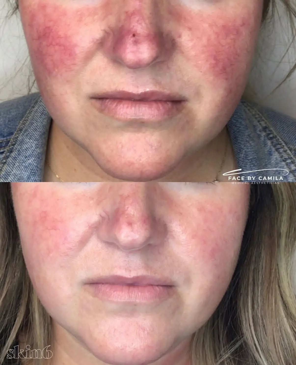 Lumecca IPL before and after results at Skin6 Toronto