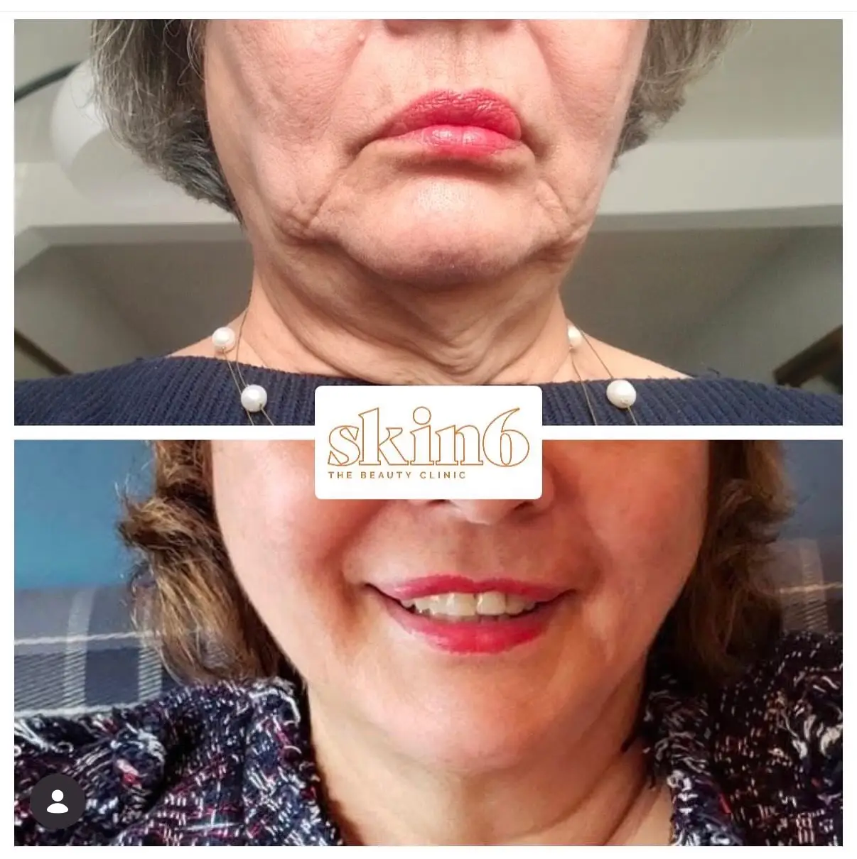Morpheus8 before and after results at Skin6 Toronto