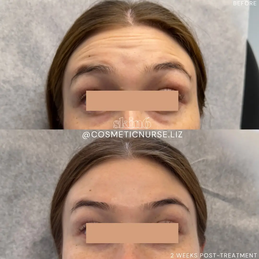 Natural refresh results at Skin6 Toronto