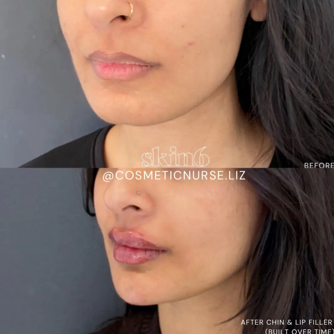 Profile balancing filler results at Skin6 Toronto