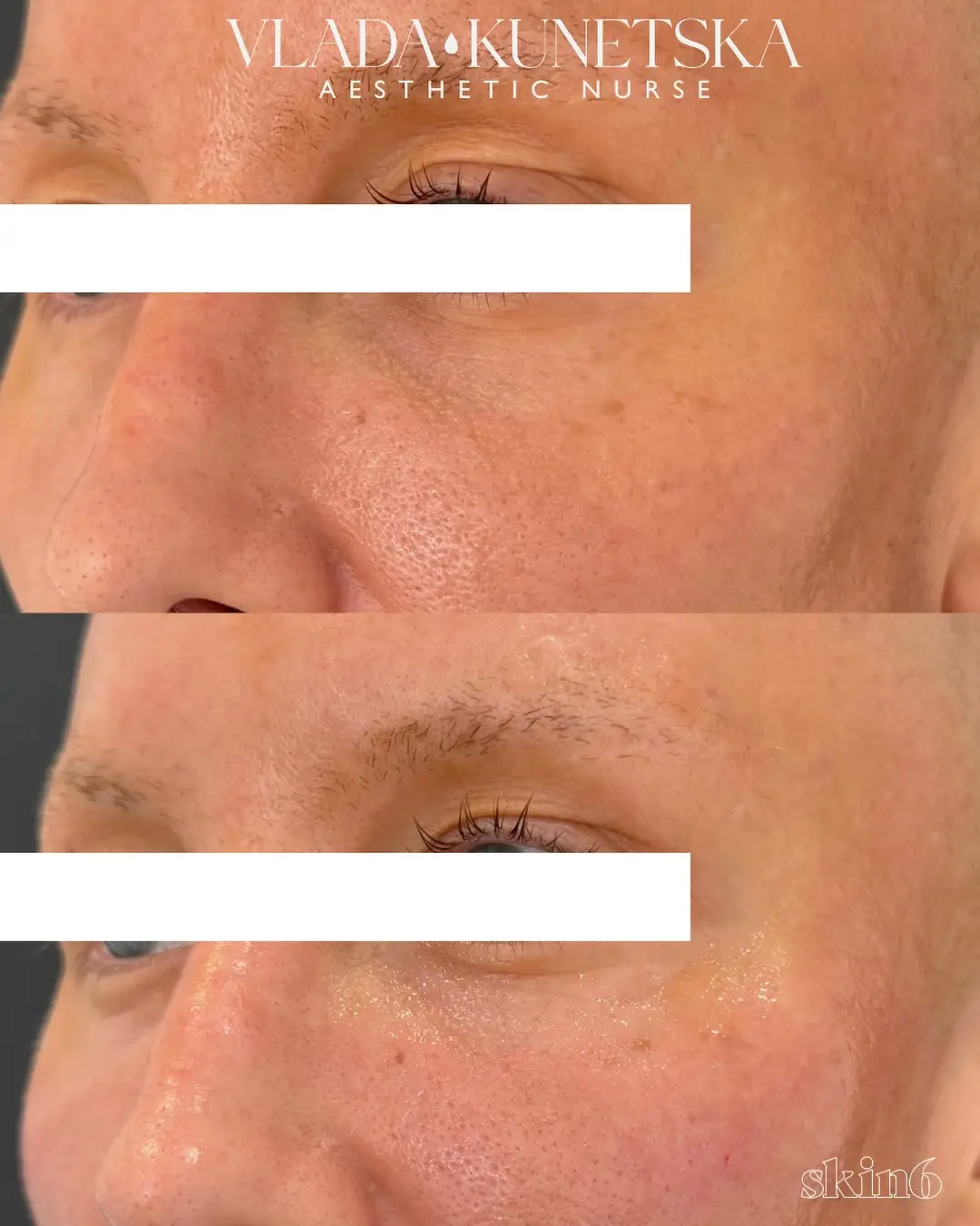 Under-eye filler before and after at Skin6 Toronto