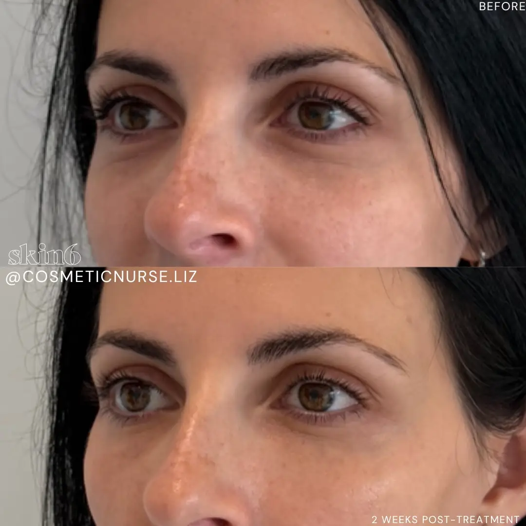 Subtle under-eye filler results at Skin6 Toronto